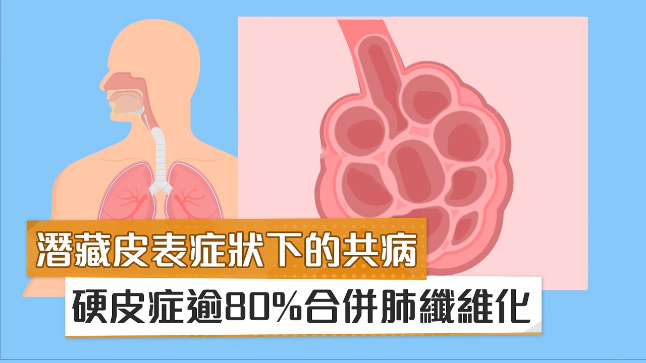 【謝松洲醫師】潛藏皮表症狀下的共病　硬皮症逾80%合併肺纖維化｜健康醫療網
