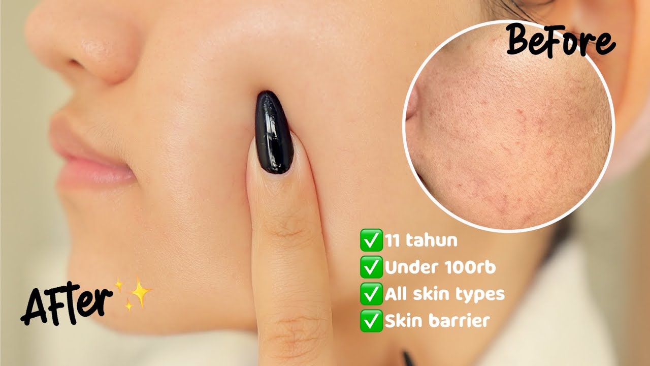 Basic Skincare Terbaik (jerawat, skin barrier, sensitif, utk semua jenis kulit!)