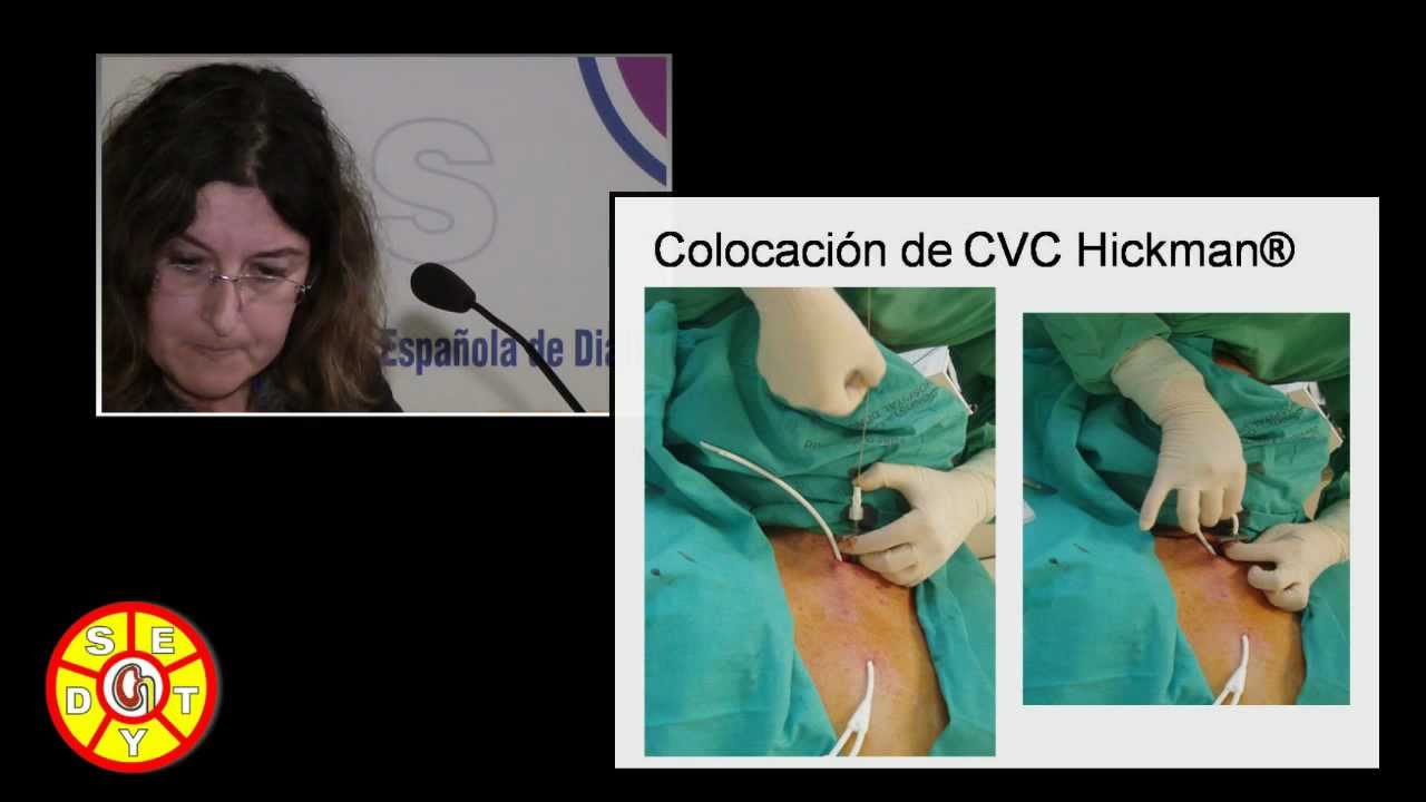 El abordaje yugular: ACCESOS VASCULARES para HEMODIÁLISIS. Dra. Mª Teresa Rodrigo