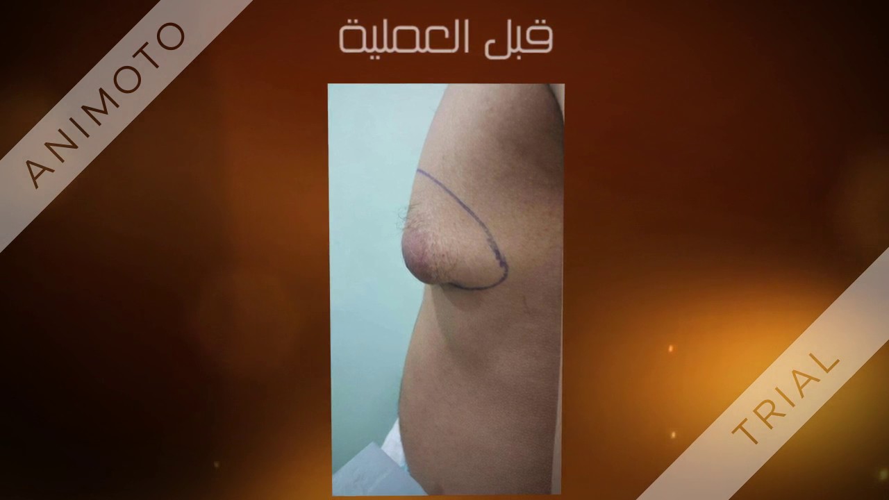 التثدي لدى الرجال ليست مشكلة وحله سهل جدا