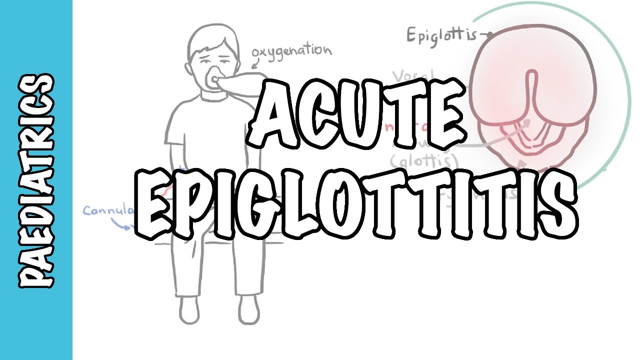 Acute Epiglottitis - signs and symptoms, causes, pathophysiology, treatment
