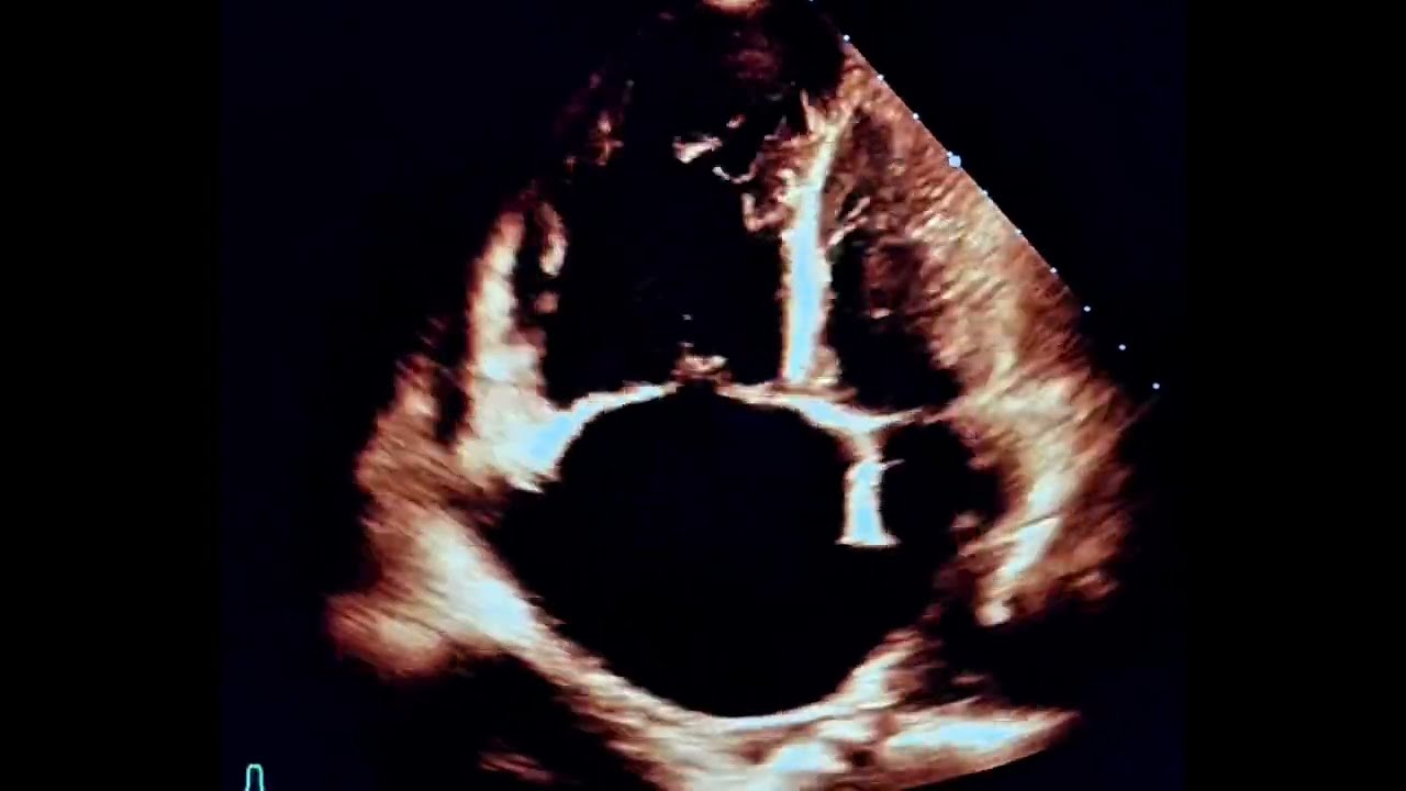 Reverse McConnell’s Sign: A Rare Echo Clue in Pulmonary Embolism