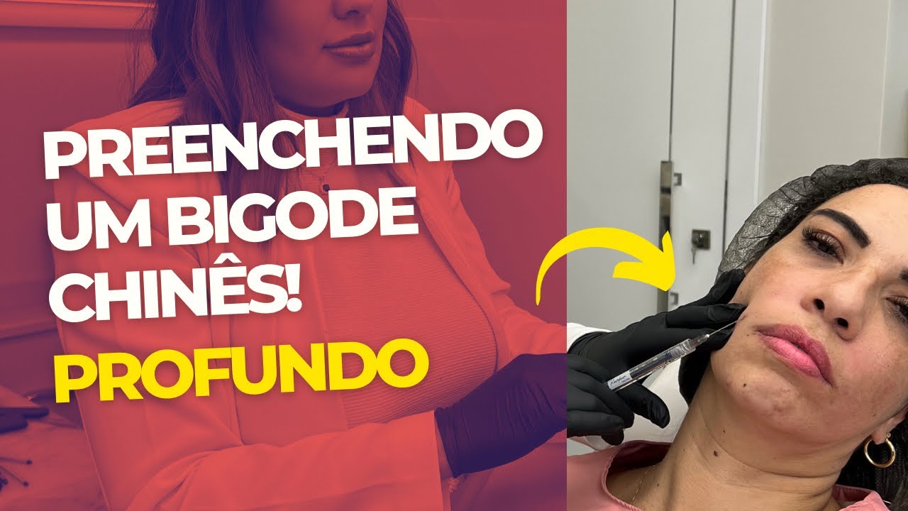 PREENCHIMENTO DE BIGODE CHINÊS | procedimento completo no sulco nasogeniano e fossa piriforme