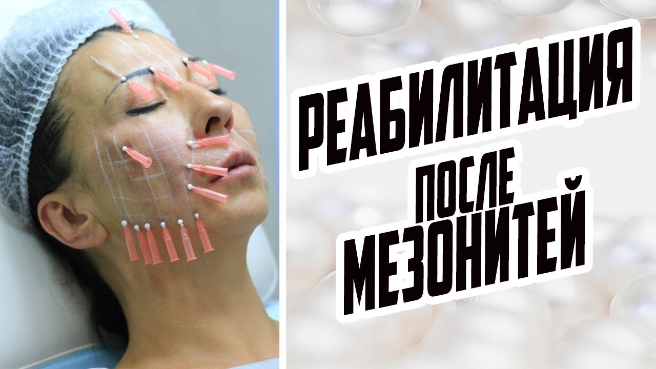 РЕАБИЛИТАЦИЯ ПОСЛЕ МЕЗОНИТЕЙ / МЕЗОНИТИ ДО И ПОСЛЕ / СКОЛЬКО ДЛИТСЯ РЕАБИЛИТАЦИЯ / СОВЕТЫ ВРАЧА