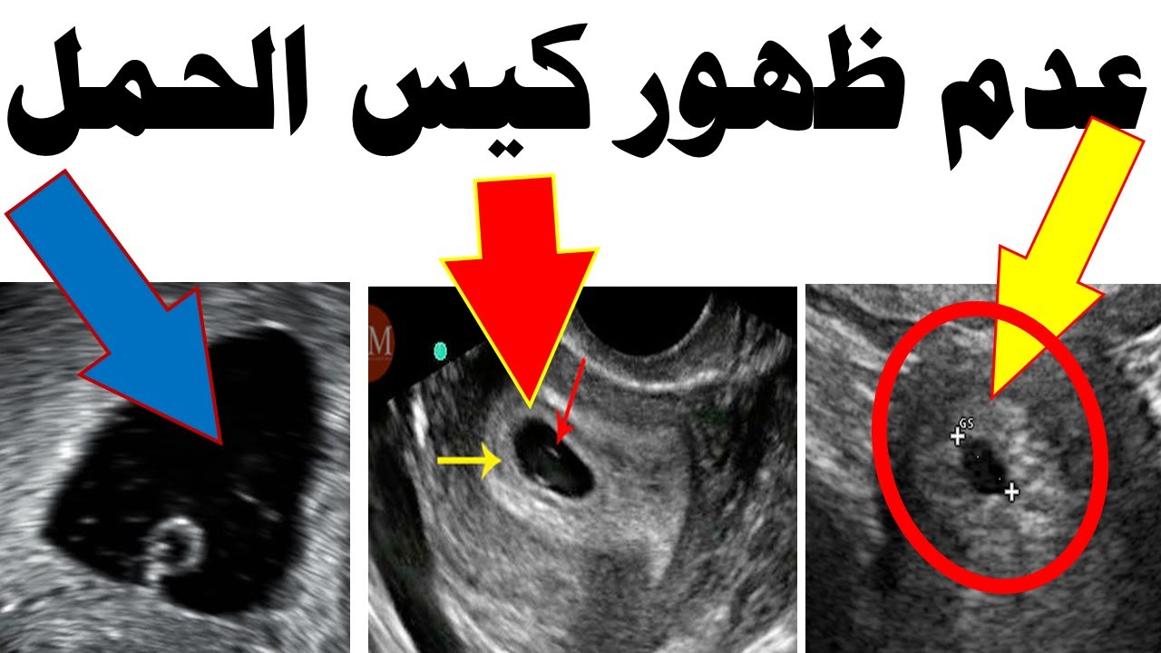 أسباب عدم ظهور كيس الحمل رغم اختبار الحمل الإيجابي | اختبار الحمل الرقمي في حالات عدم ظهور كيس الحمل
