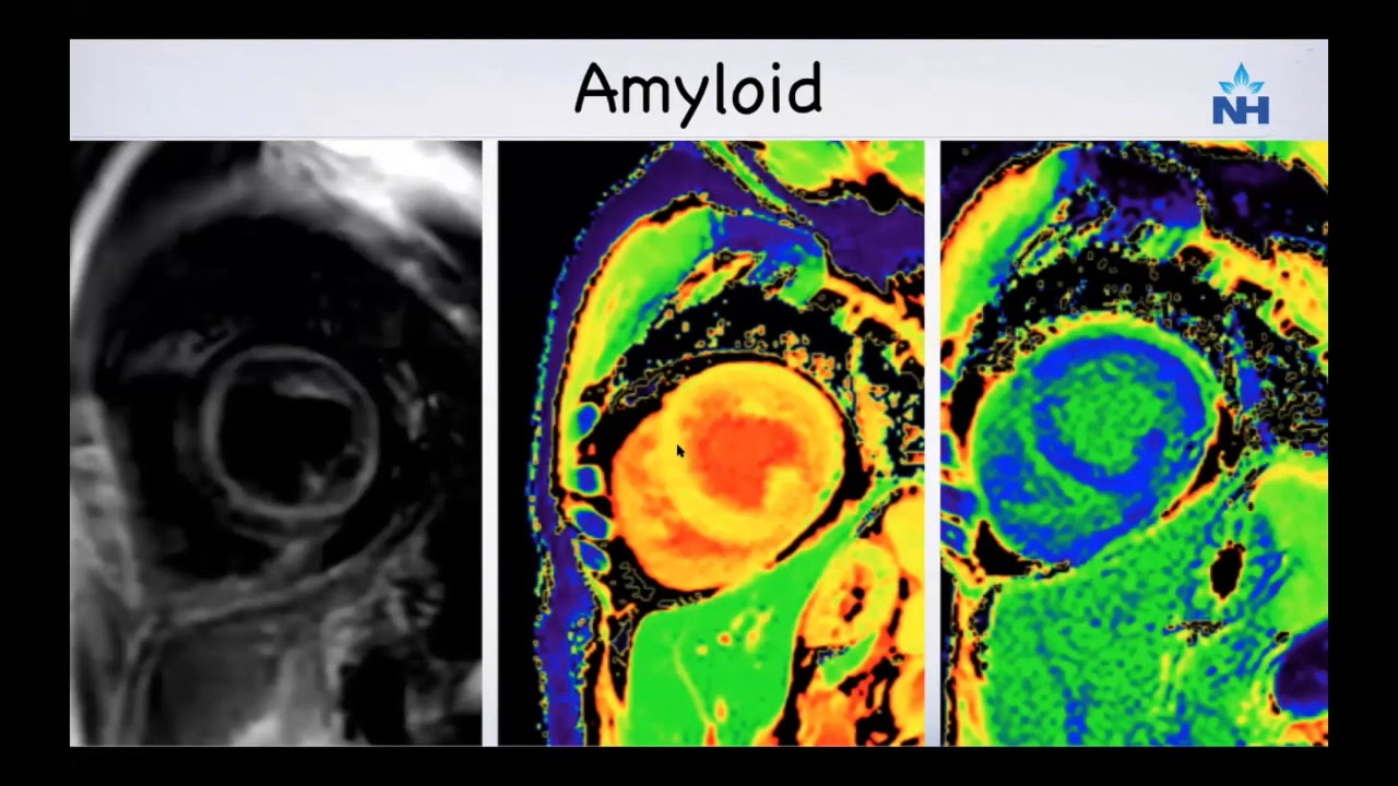 Role of CMR (Cardiac MRI) in Day to Day Practice
