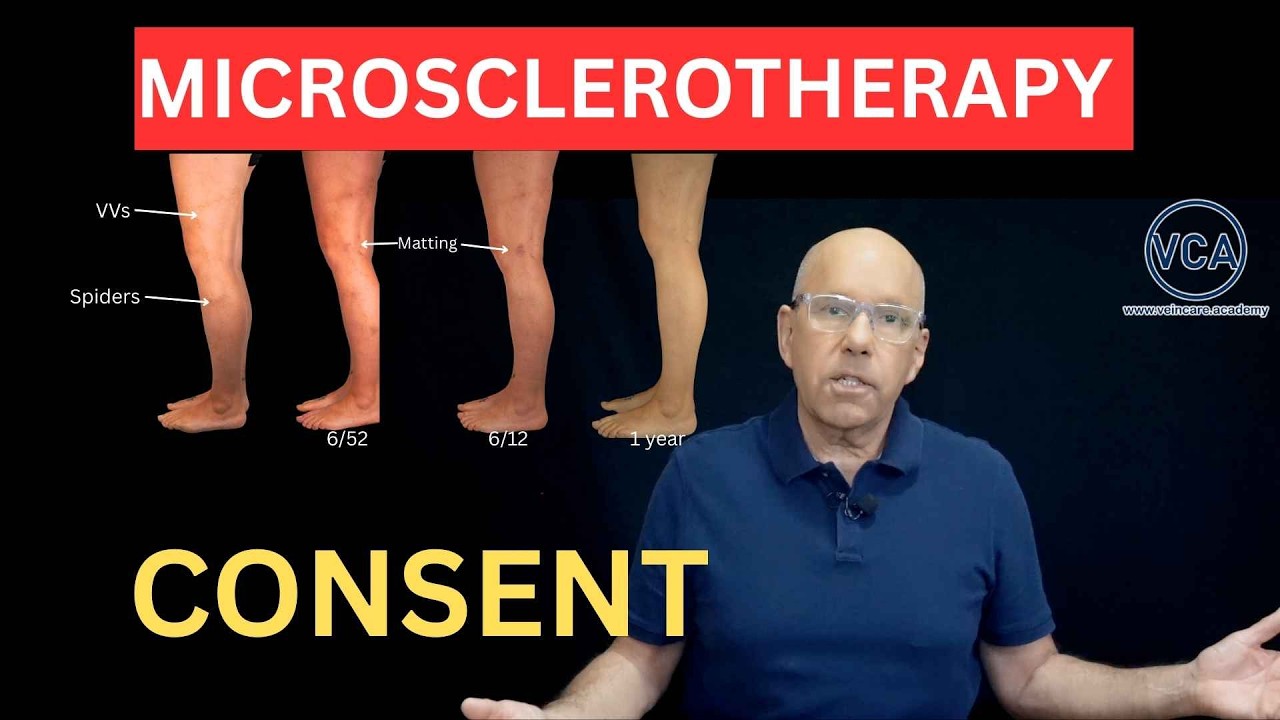 Spider Vein Treatment: The Microsclerotherapy Consent Mistake That Could Cost You Your Licence