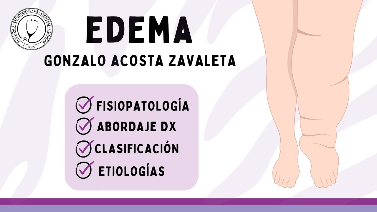 EDEMA: Fisiopatología, Abordaje diagnóstico, Clasificación y Etiologías | Semiología