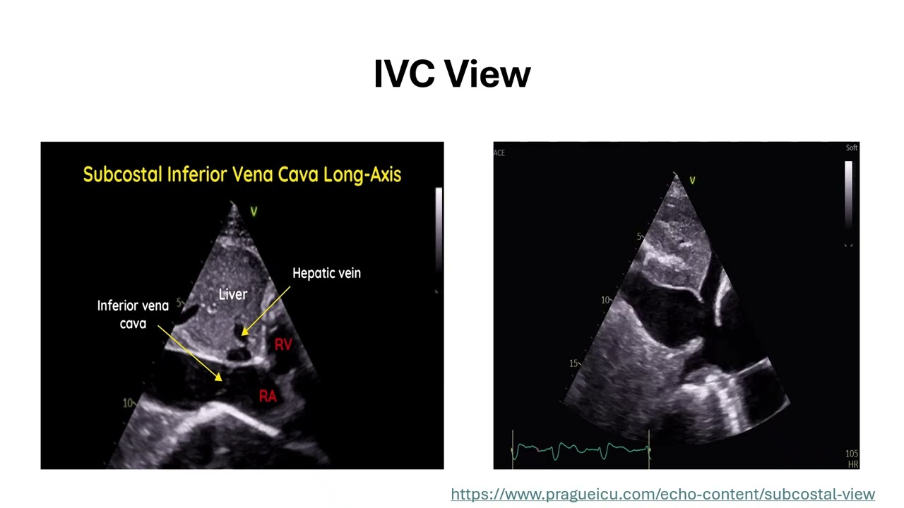 Basic Introduction To Cardiac POCUS Pt. 1 - (Dr. Mirrakhimov)