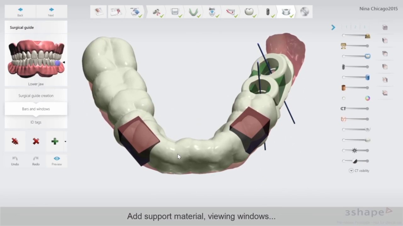 Surgical Guides Created with 3Shape