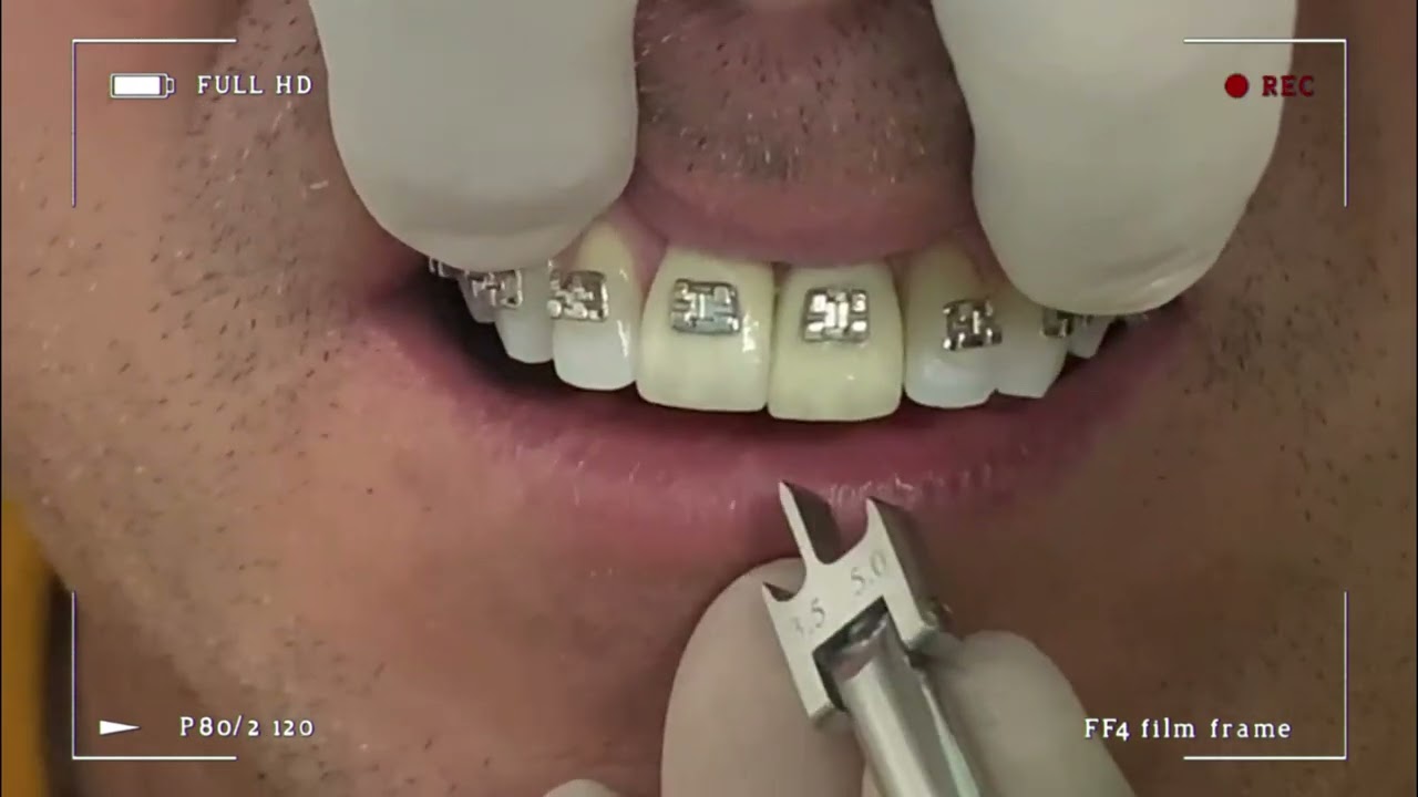 Dica que posicionamento de braquete | Dicas de Ortodontia Com Dr. Luis Amaral