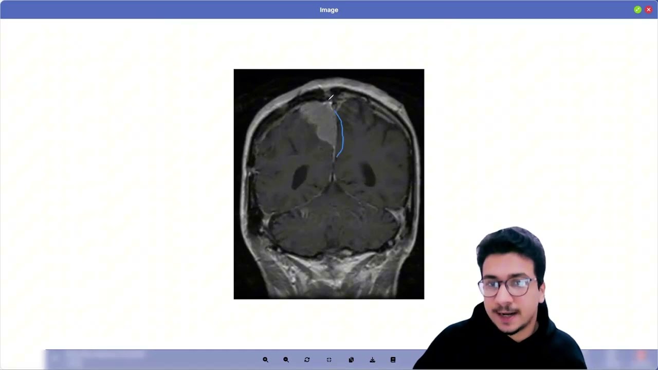 HY USMLE Q#4  - NEURO : How to Think in Neuro UWorld (Real Example)