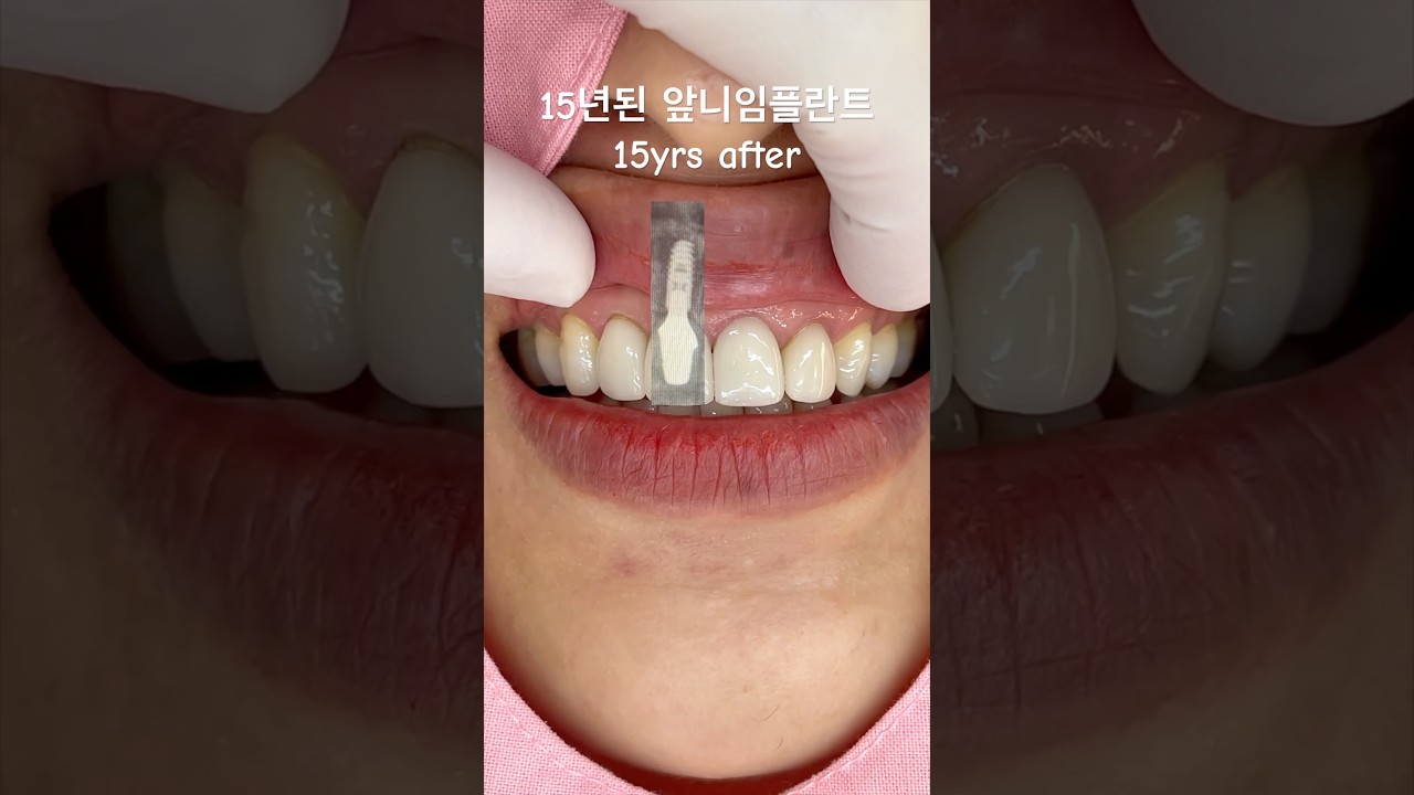 15 years after front tooth implant👍 #dental #dentist #smile  #dentistry #esthetic