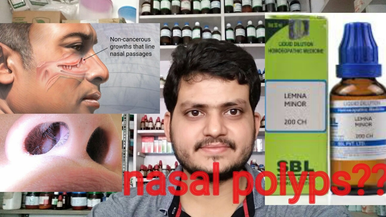 Nasal polyps!Homeopathic medicine for nasal polyps??  explain?