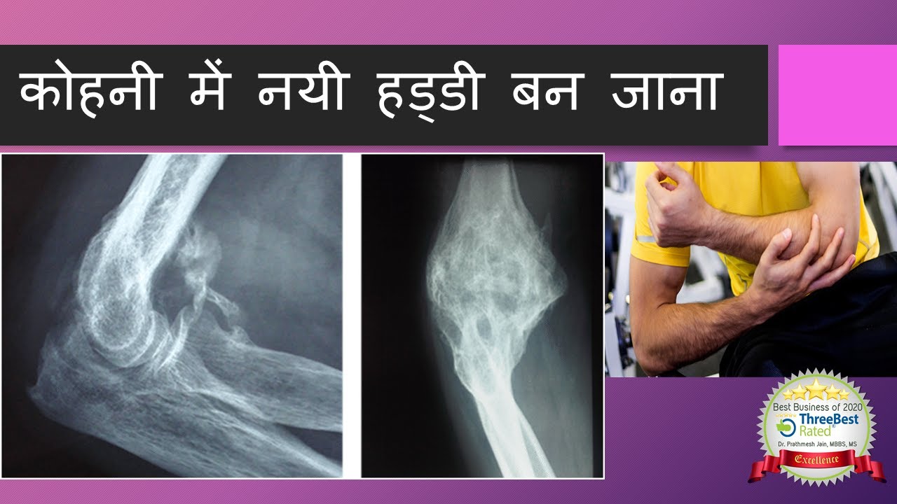 Heterotrophic ossification in Hindi  कोहनी में नयी हड्डी बन जाना