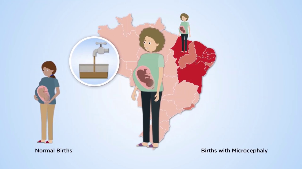 Why did Zika cause more birth defects in Northeast Brazil?