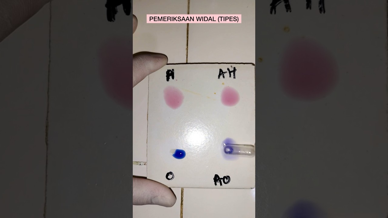 HASIL TES WIDAL POSITIF PENYAKIT TIPES‼️ #shorts
