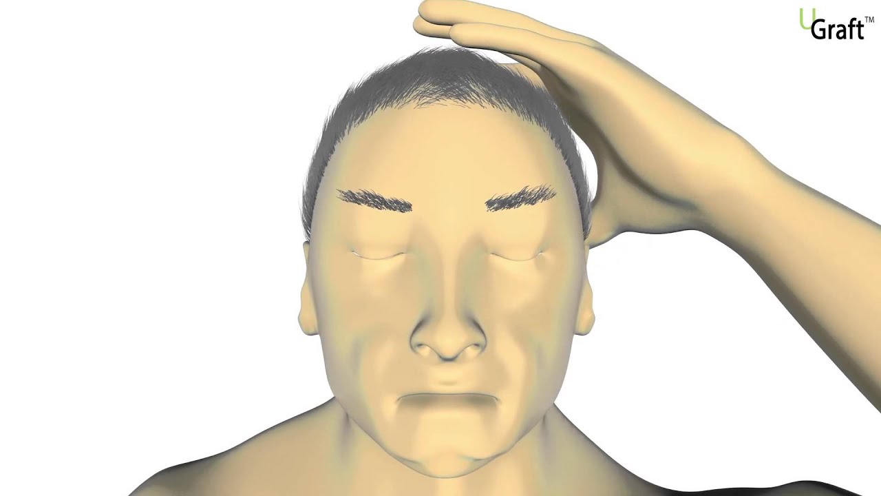 What is UGraft Advanced FUE? Results from FUE Hair Transplant