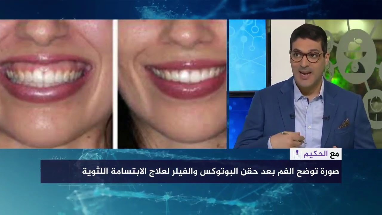 البوتكس والليزر والجراحات التجميلية أحدث علاجات الابتسامة اللثوية