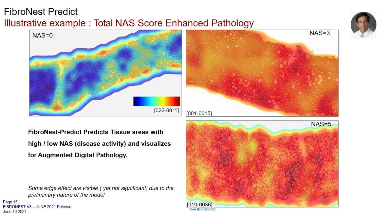 NAFLD/MAFLD: All we need to know by Dr. Arun Sanyal