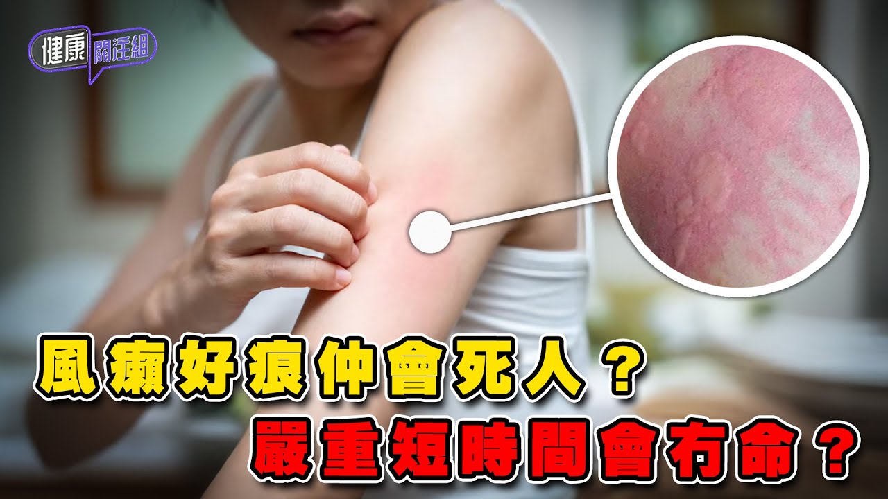 風癩好痕仲會死人？嚴重短時間會冇命？｜ 健康關注組 ｜ EP345 ｜ 風癩 ｜ 蕁麻疹 ｜ 敖嘉年 ｜ 麥詩敏 ｜ HOY TV 77台