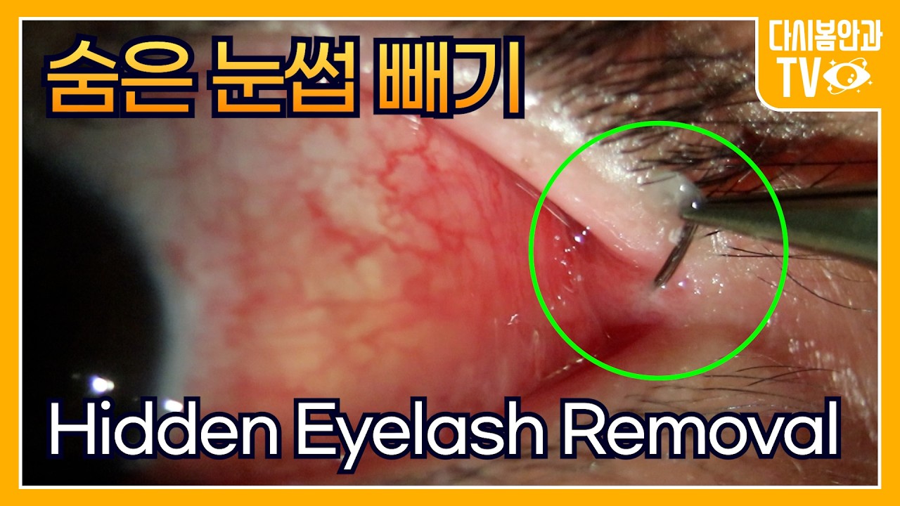 Hidden Eyelash Removal