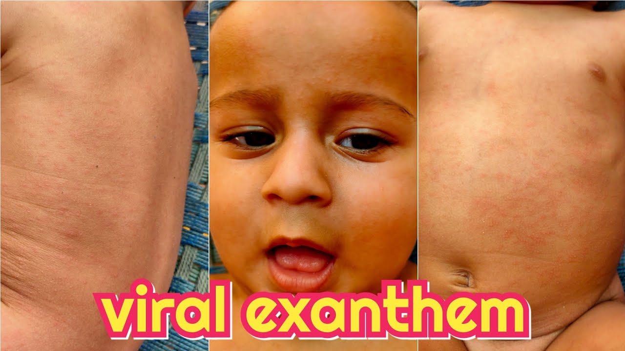 Baby has viral exanthem || viral rashes