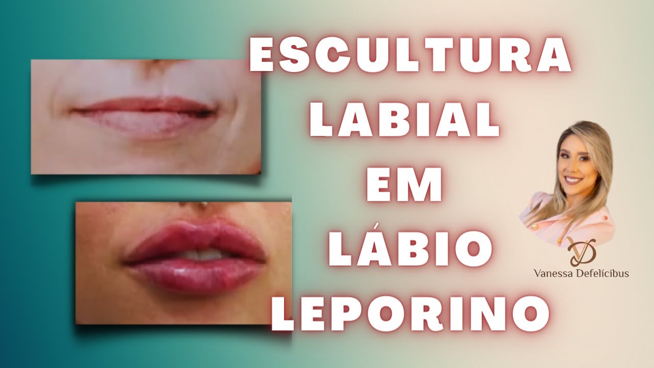 TÉCNICA DE CORREÇÃO DO LÁBIO LEPORINO | Método Escultura labial