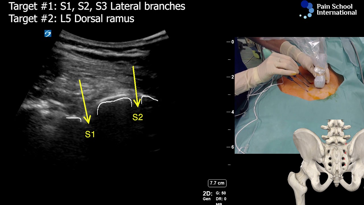 Dr Agnes Stogicza - Radiofrequency E-Learning Seminar 1 Session 4: Sacroiliac joint denervation