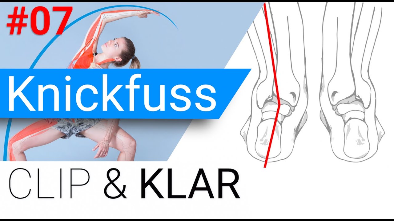 Knickfuss erkl&auml;rt - Ferse aus dem Lot