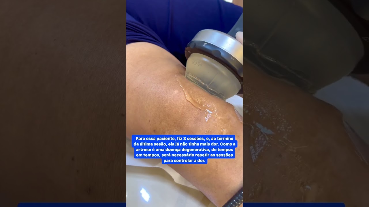 Tratamento pra artrose avançada (grau 4) no joelho com as ondas de choque.