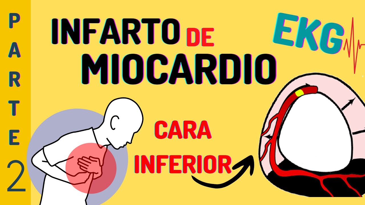 INFARTO DE MIOCARDIO DE CARA INFERIOR CON CASO CLÍNICO (PARTE 2) - EKG FÁCIL