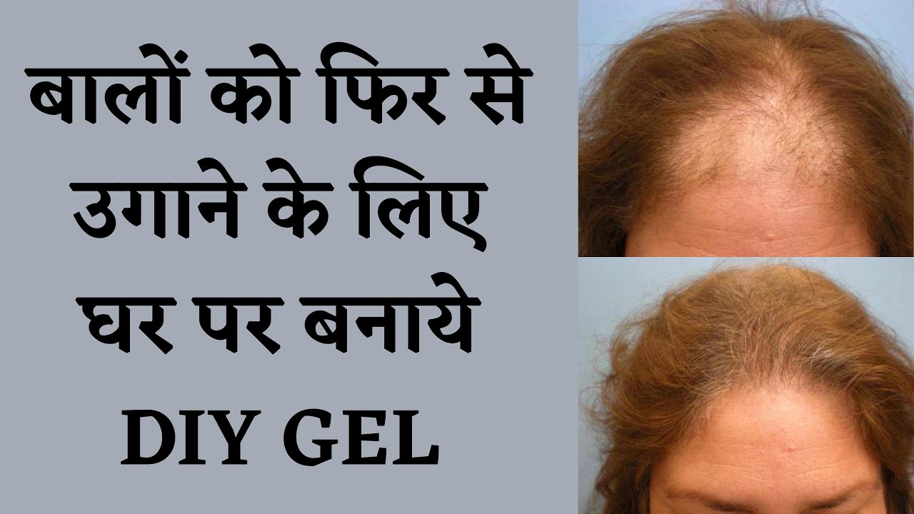 Hair Regrowth Gel for Hair Growth | बालों को फिर से उगाने के लिए घर पर बनाये DIY GEL I DR. MANOJ DAS