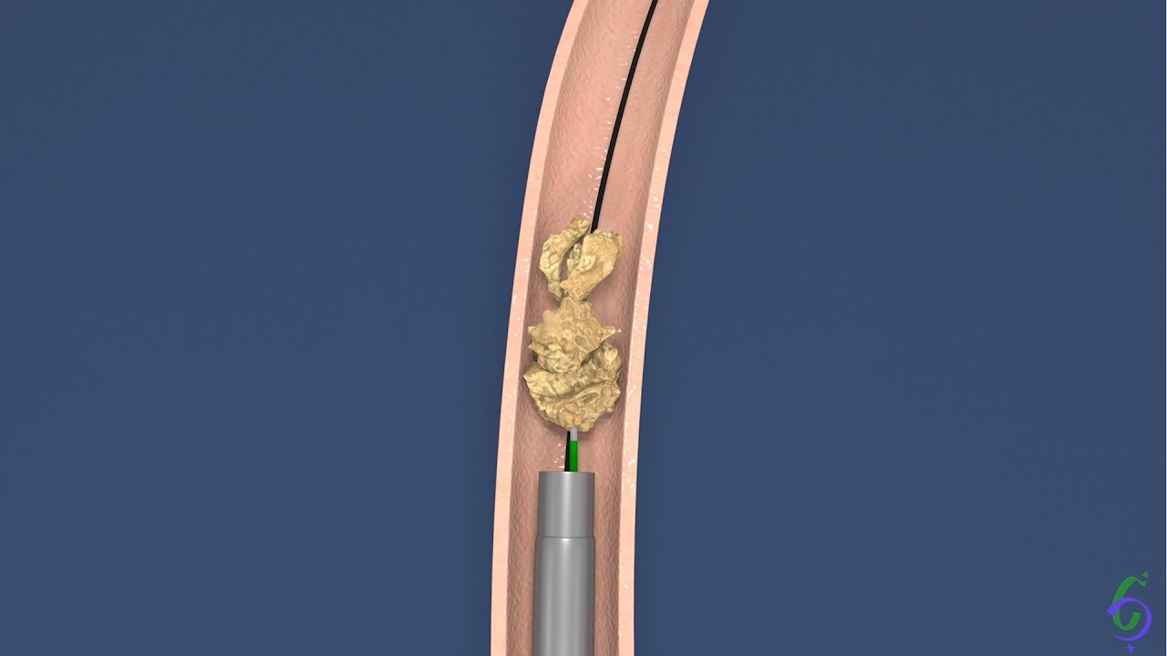 Ureterolitotripsia Rigida - Animação cirurgia de pedra no ureter - Tratamento de cólica renal