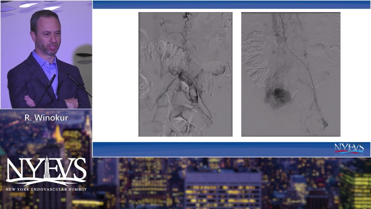 ClotTriever for Acute DVT   Ronald Winokur  Venous Symposium