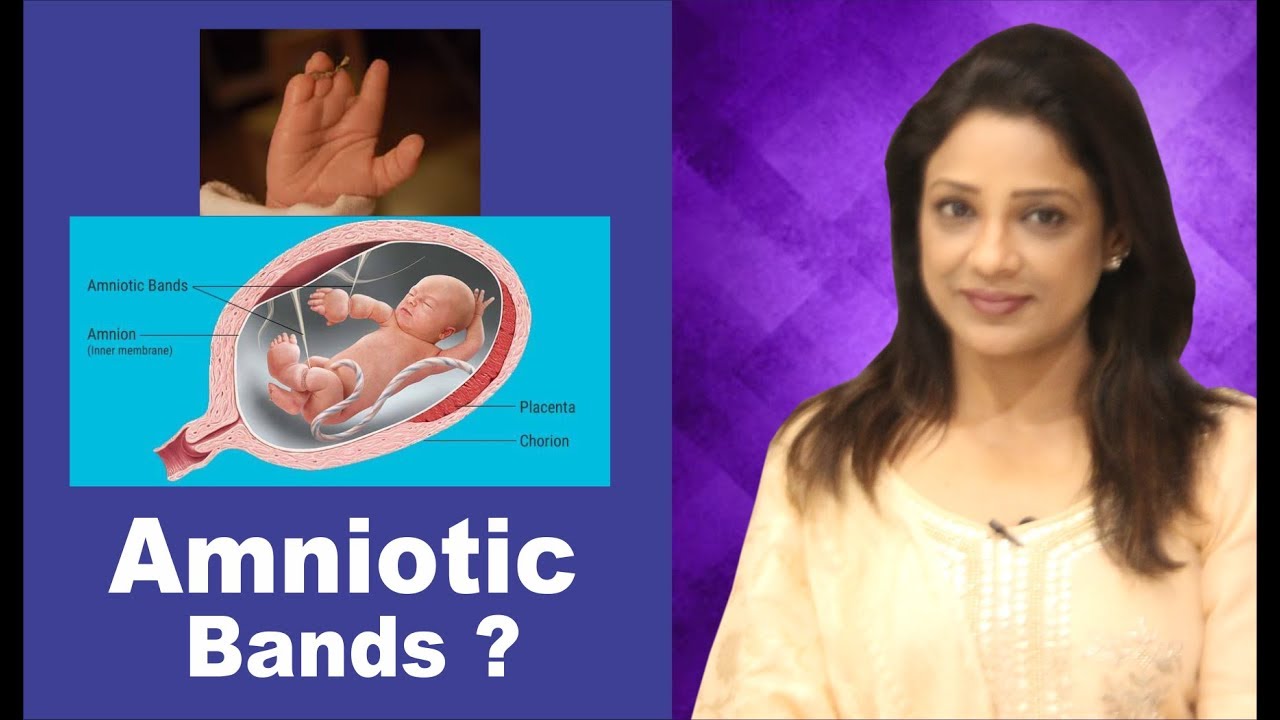 How are Amniotic Bands formed?