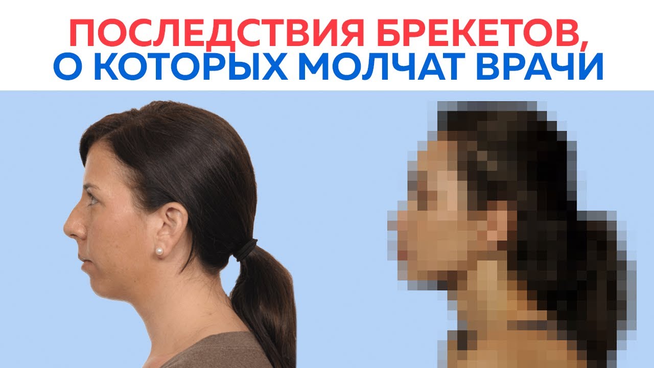 Брекеты меняют лицо! Правда или нет?! / О чём не говорят врачи - ортодонты?