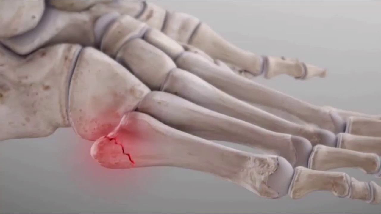 FRACTURA DEL QUINTO METATARSIANO, FRACTURA DEL DEPORTISTA SIGNOS SÍNTOMAS Y TRATAMIENTO, FRACTURAS