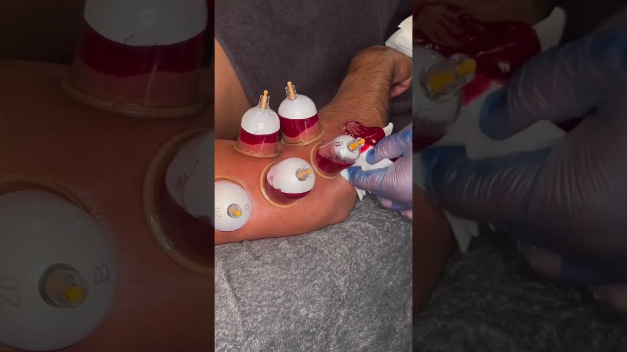 Hijama therapy for Tennis elbow #treatment #shorts