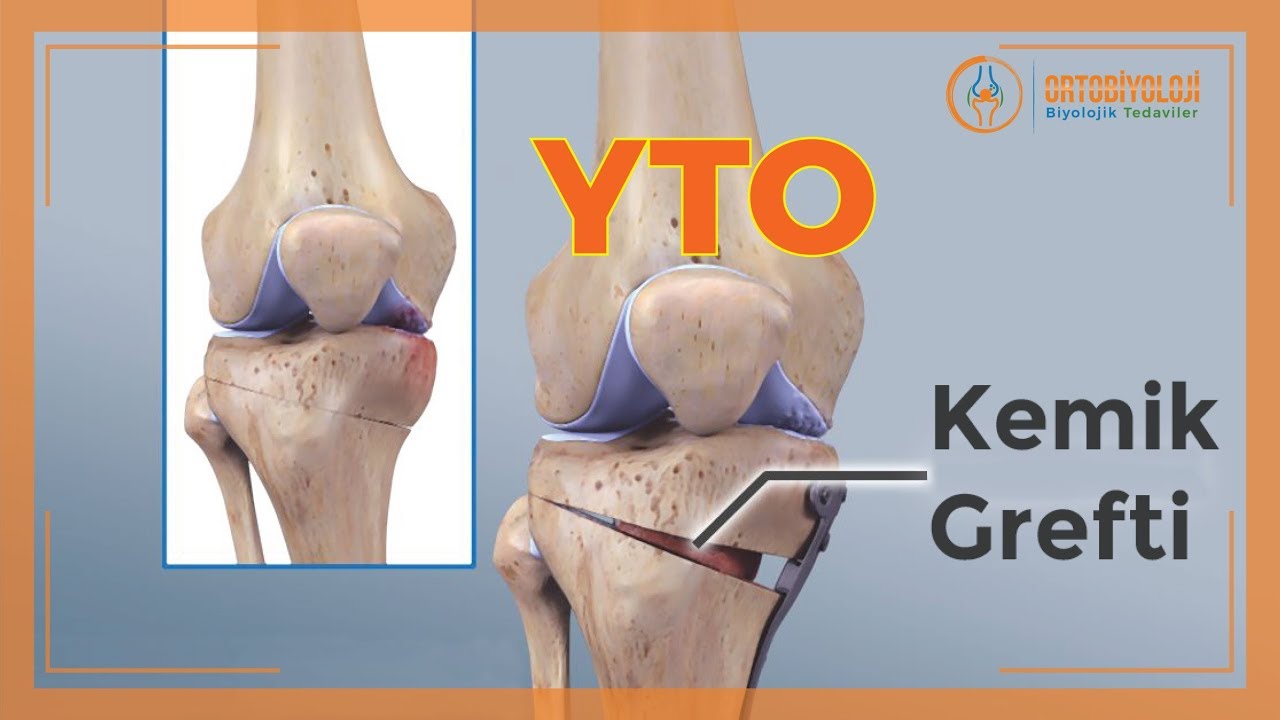 YÜKSEK TİBİAL OSTEOTOMİ TEDAVİSİ