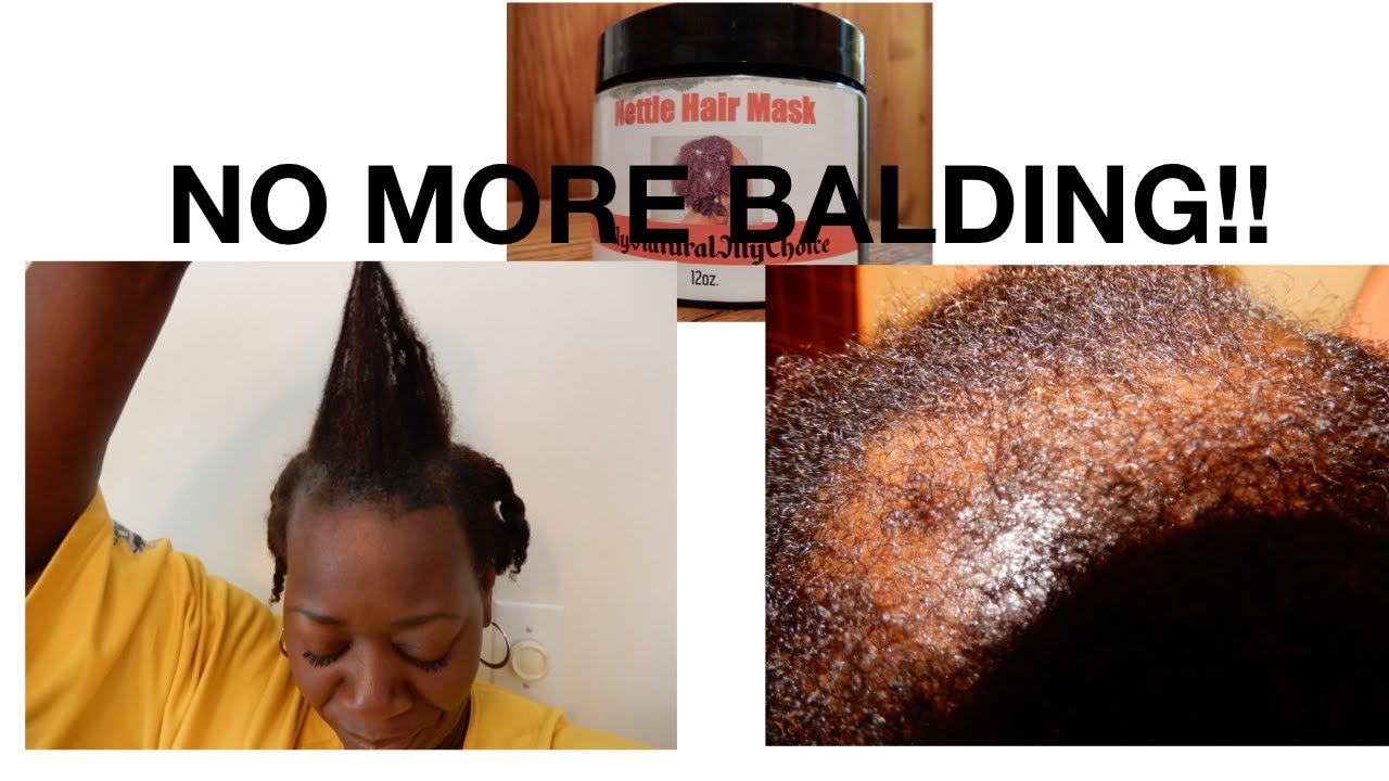 No More Balding!! Stinging Nettle Hair Mask