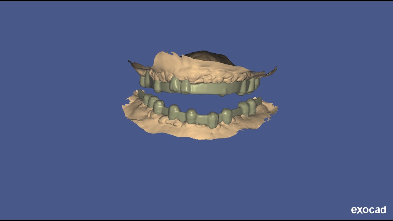 Bar designing for lower mu implants in exocad - best laser dental clinic