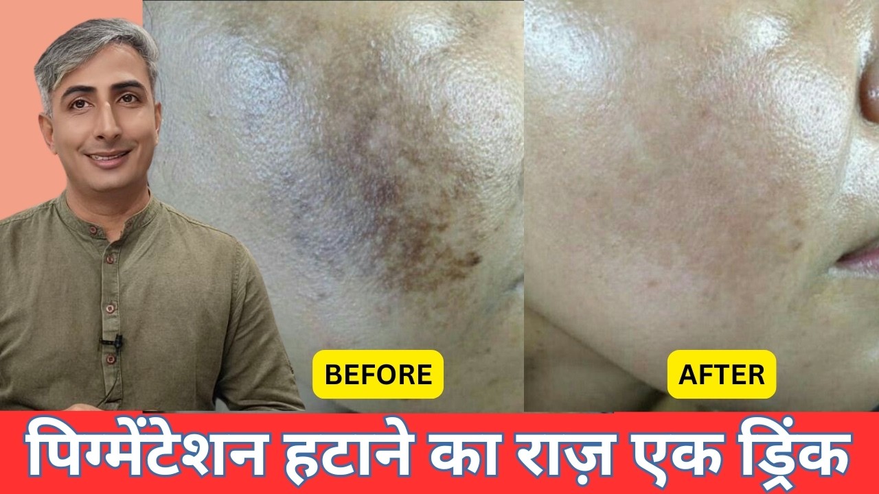 सालों पुराना पिग्मेंटेशन हुआ गायब I चेहरे का रंग निखरेगा I DR. MANOJ DAS I #drmanojdas