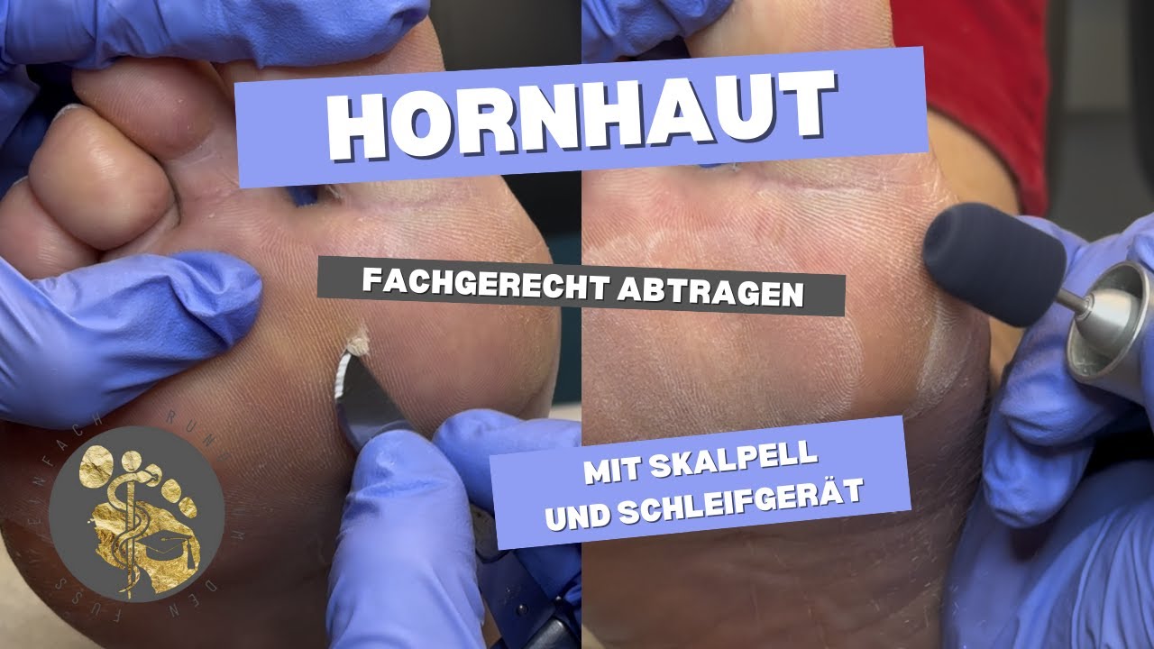 Hornhaut professionell entfernen – Schritt für Schritt! | Einfach rund um den Fuß 👣