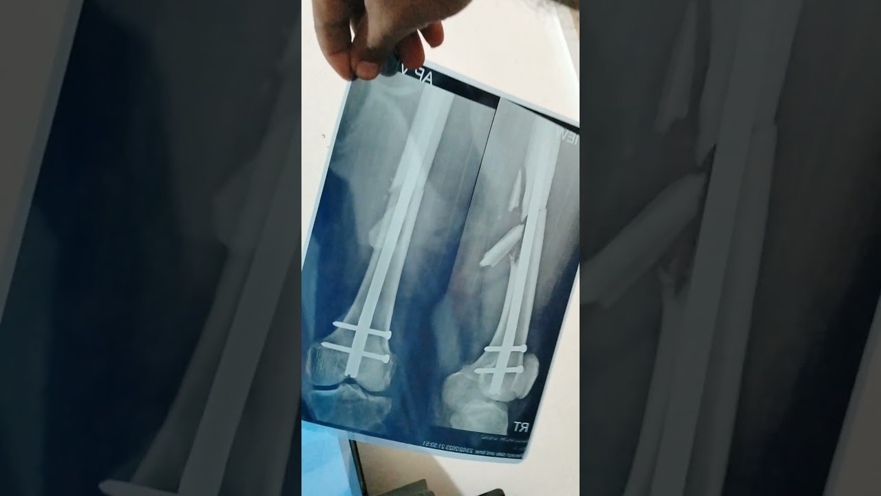Inkjet x-ray Results || Inkjet printer for X-rays #xray #printertulungagung