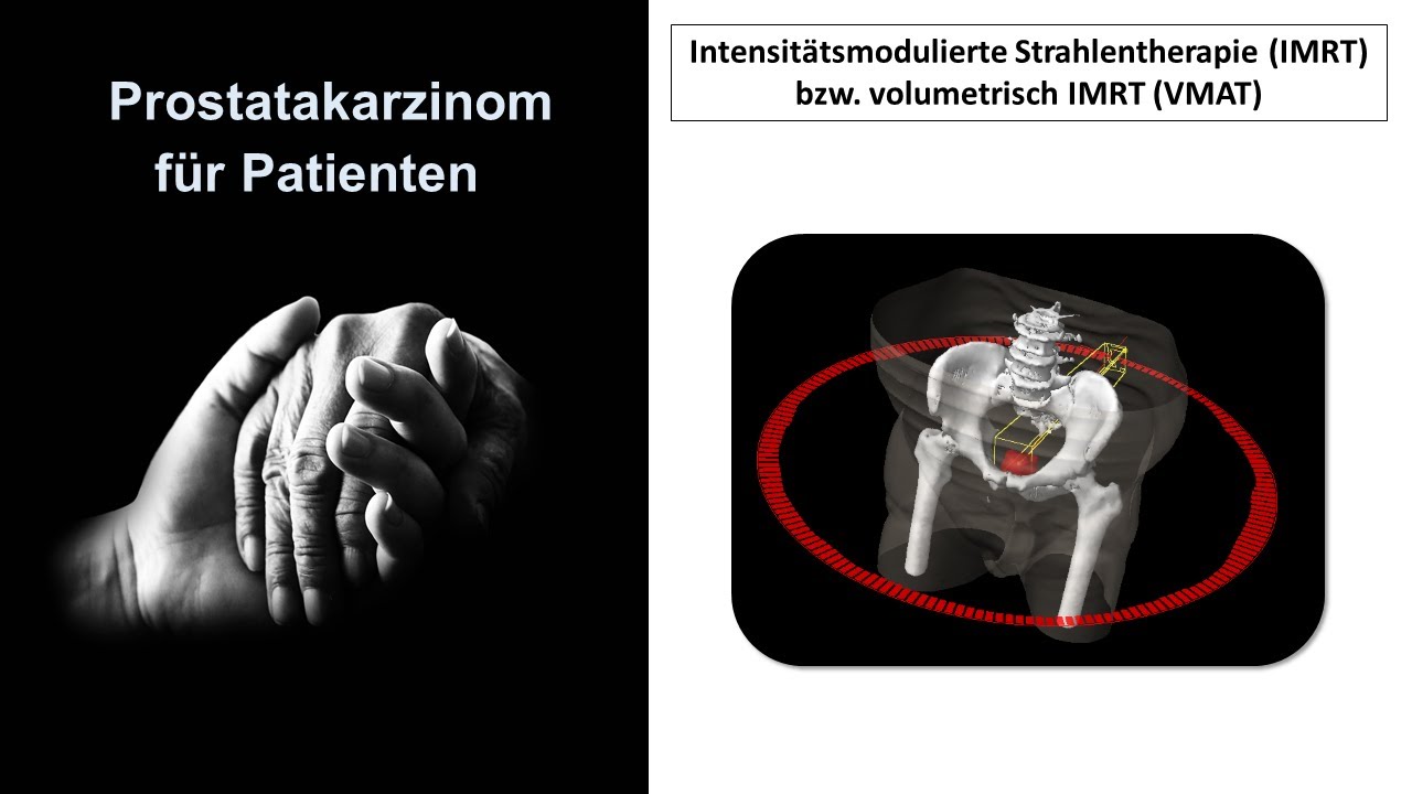 Prostatakarzinom für Patienten - Bestrahlung mit IMRT | Prof. Hilke Vorwerk