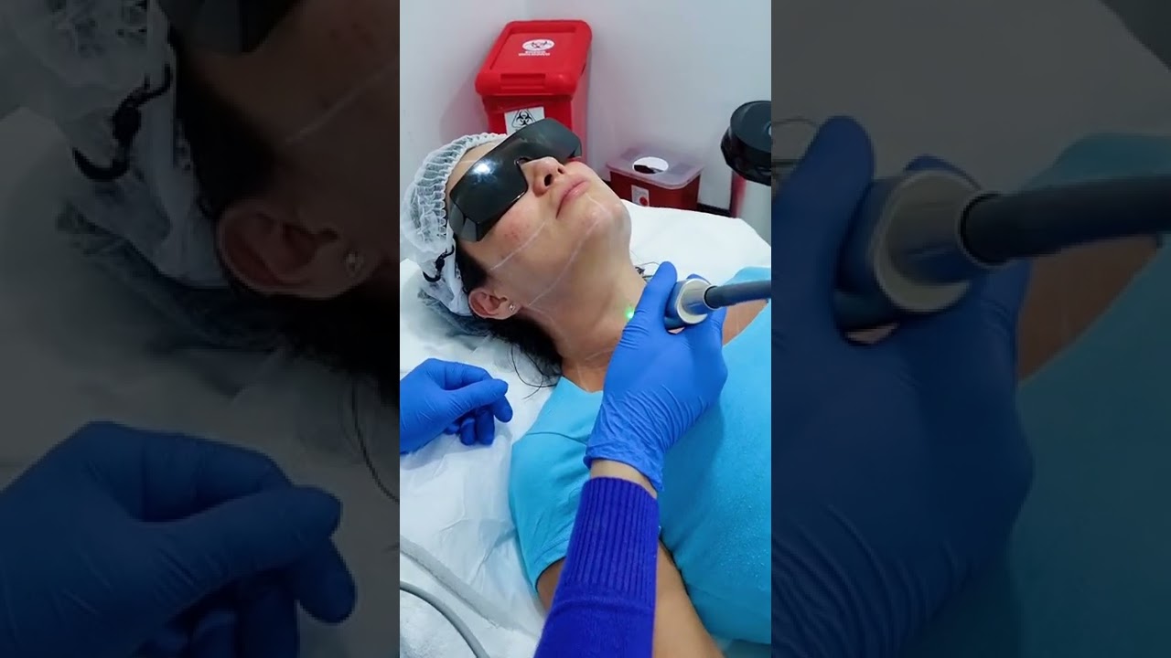 Rejuvenecimiento de cuello y escote con Laser Fotona #laserfotona #escote #cuello #estetica #tensado