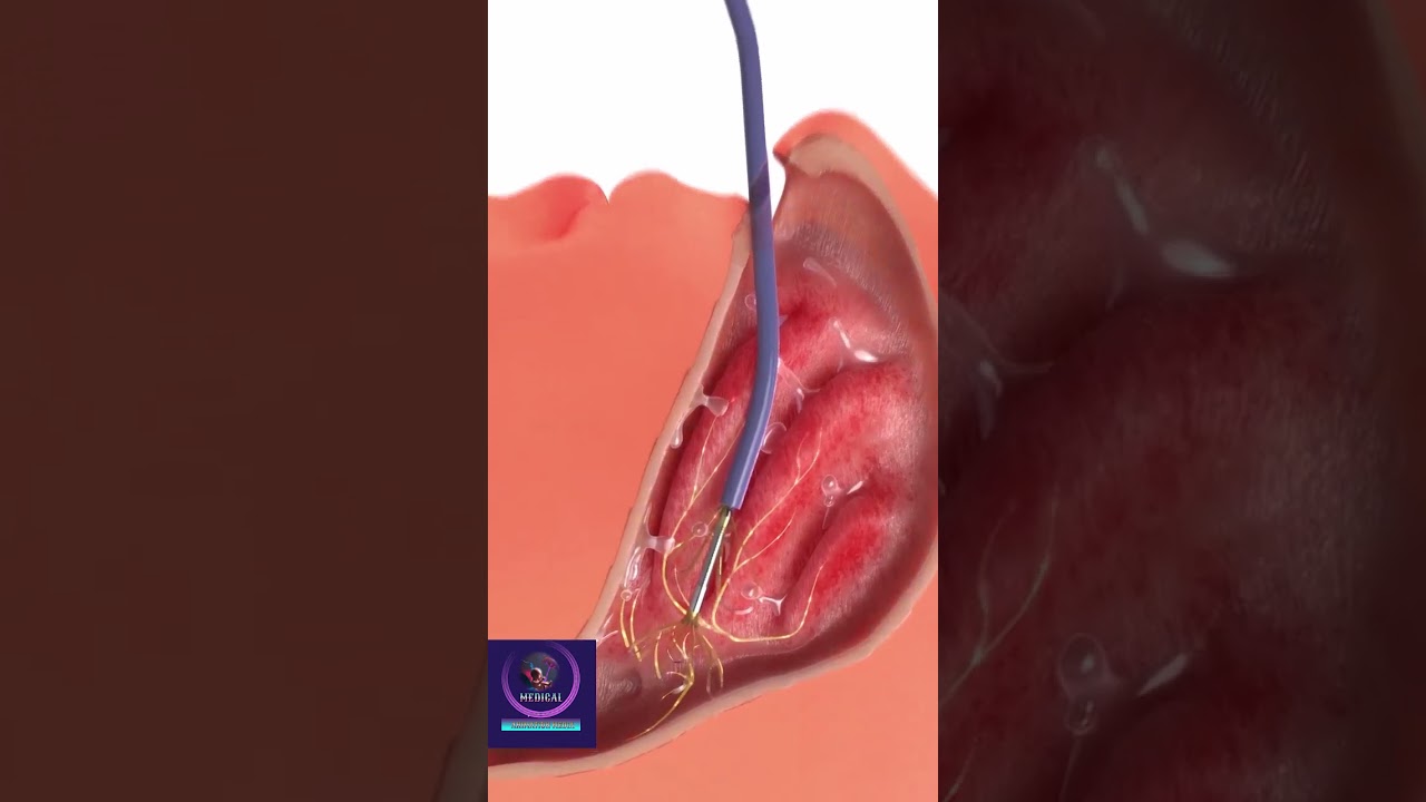 Nasal Turbinate Surgery #shorts