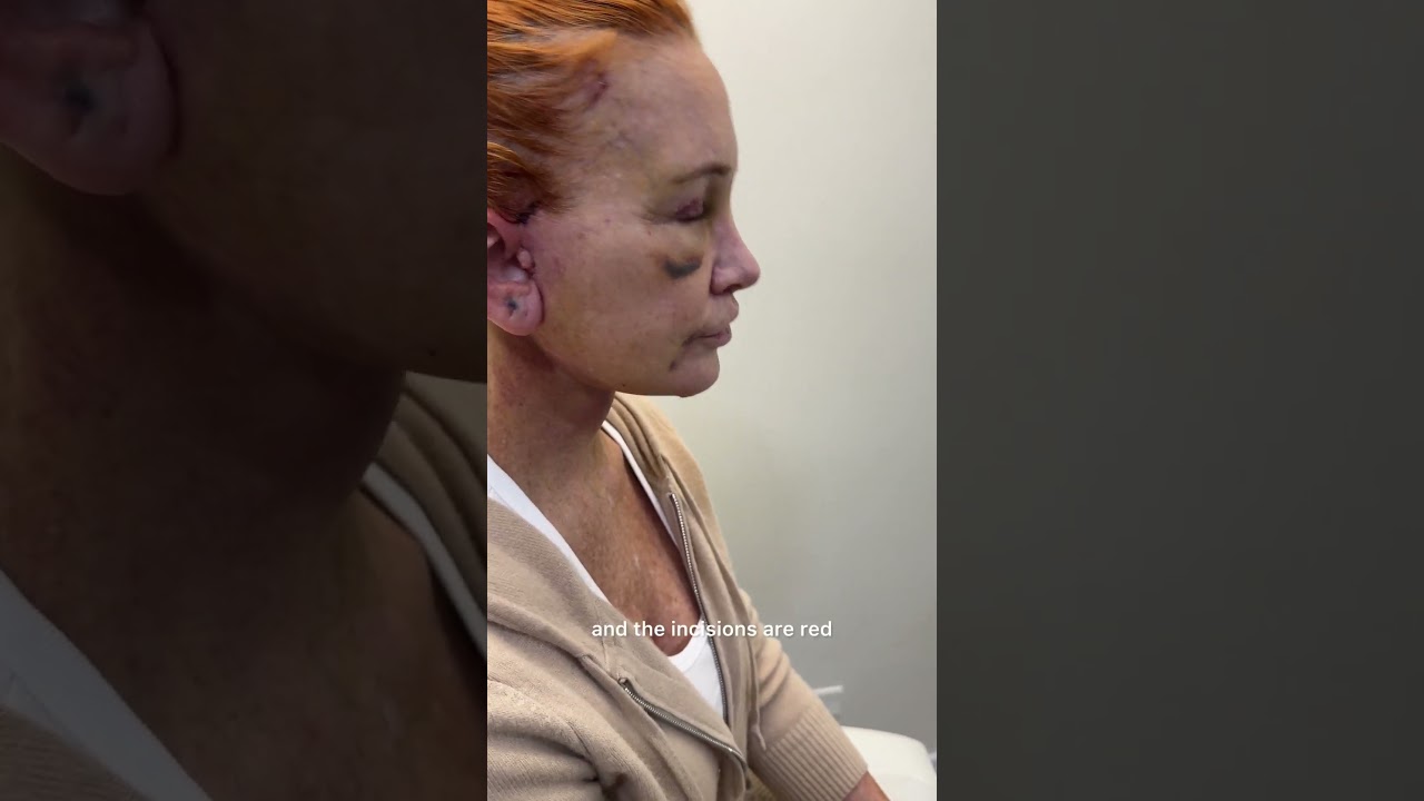 Facial Rejuvenation PART 3: Recovery From Full Face Rejuvenation