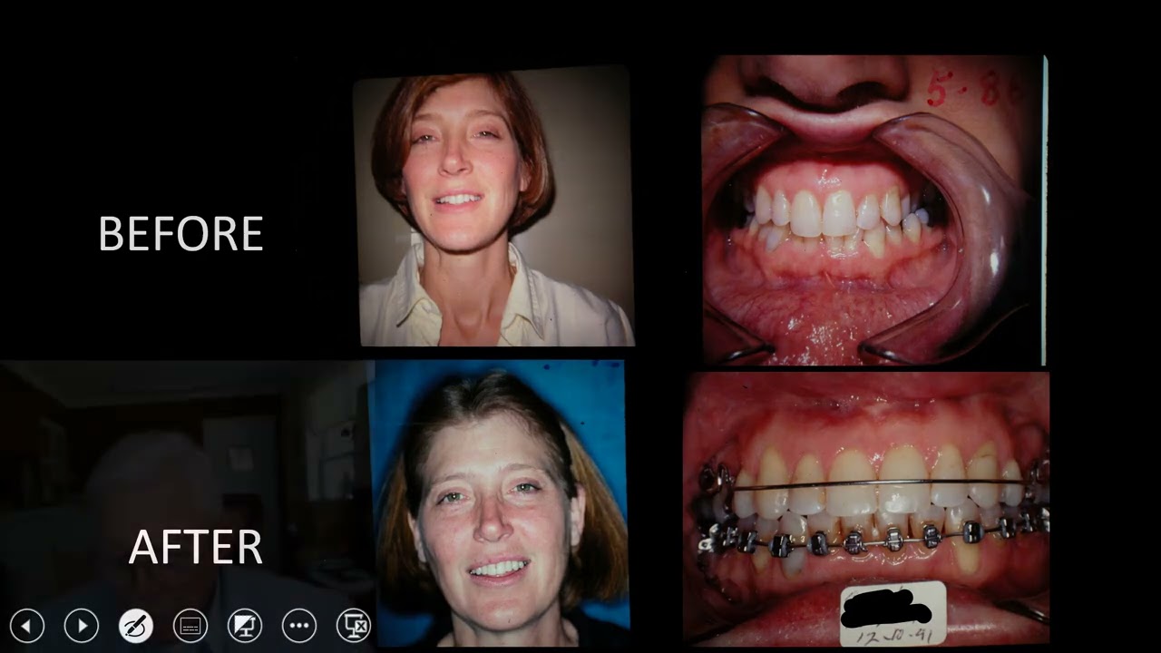 Botched Case Repair - Using Reverse Headgear, Upper Lip Bumper and Space Opening